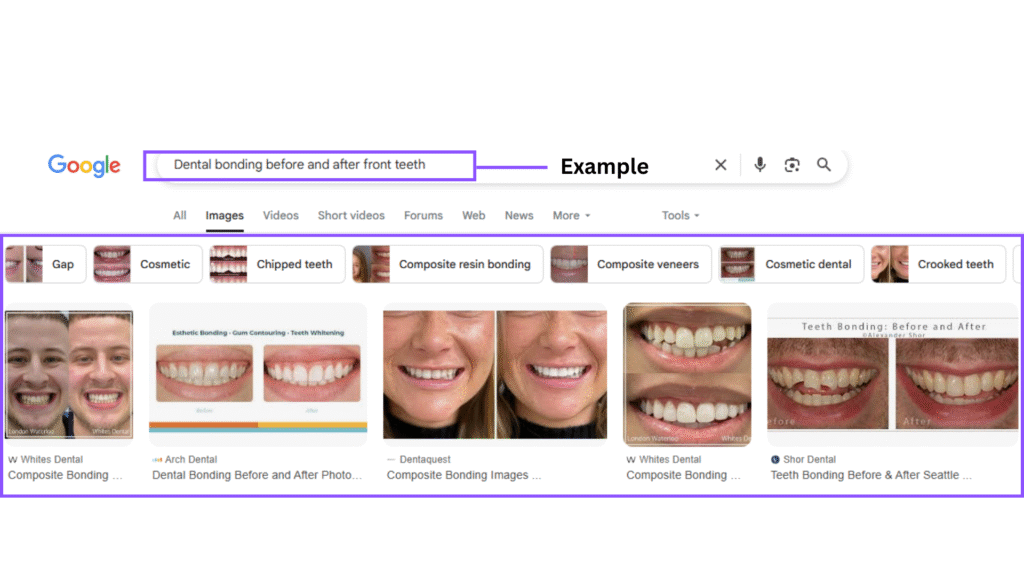 SEO for cosmetic dentists Google Images search results showing dental bonding before and after photos